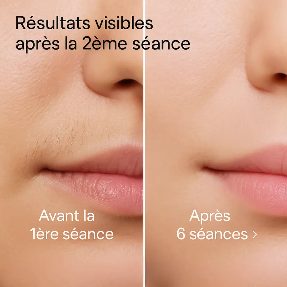 Épilateur IPL Skinovaa Pro Expert – Épilation Définitive Corps & Visage – Image 3